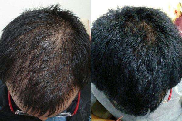 На фото – сравнение волос при лечении «Миноксидилом»
