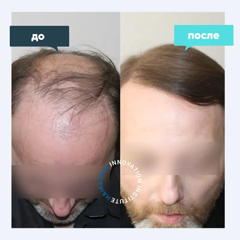 Пересадка волос у мужчин