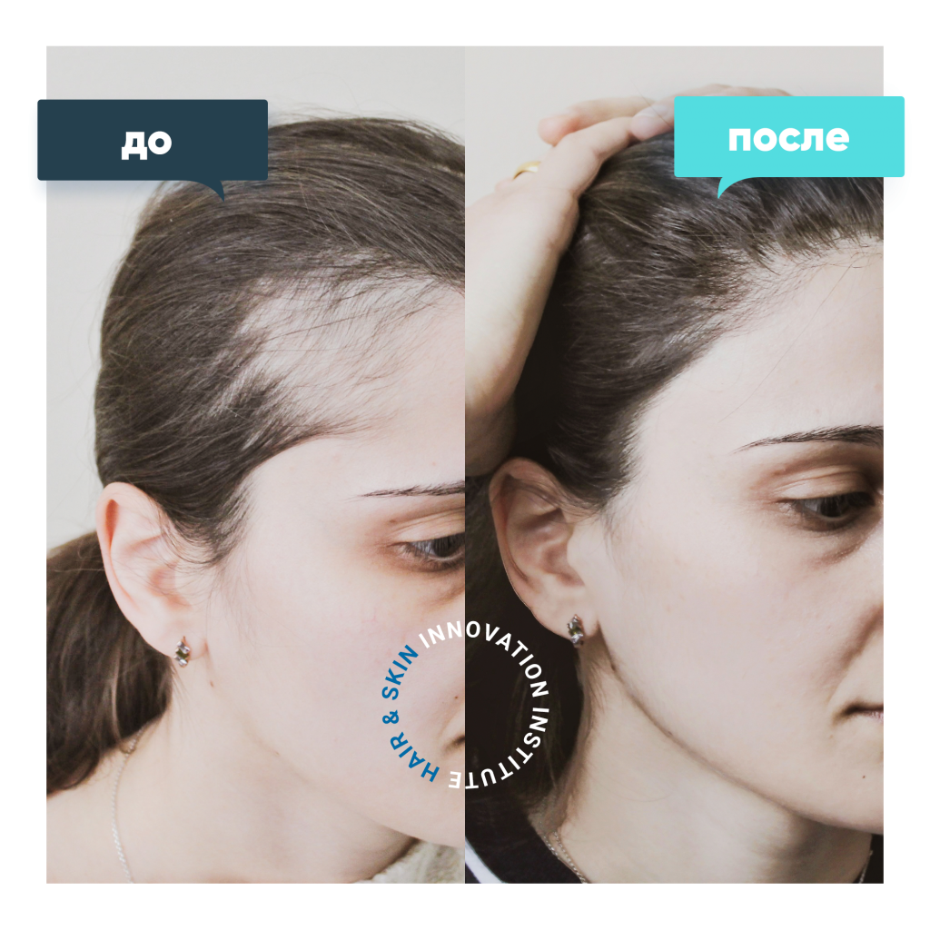 Фото до и после пересадки волос у женщин