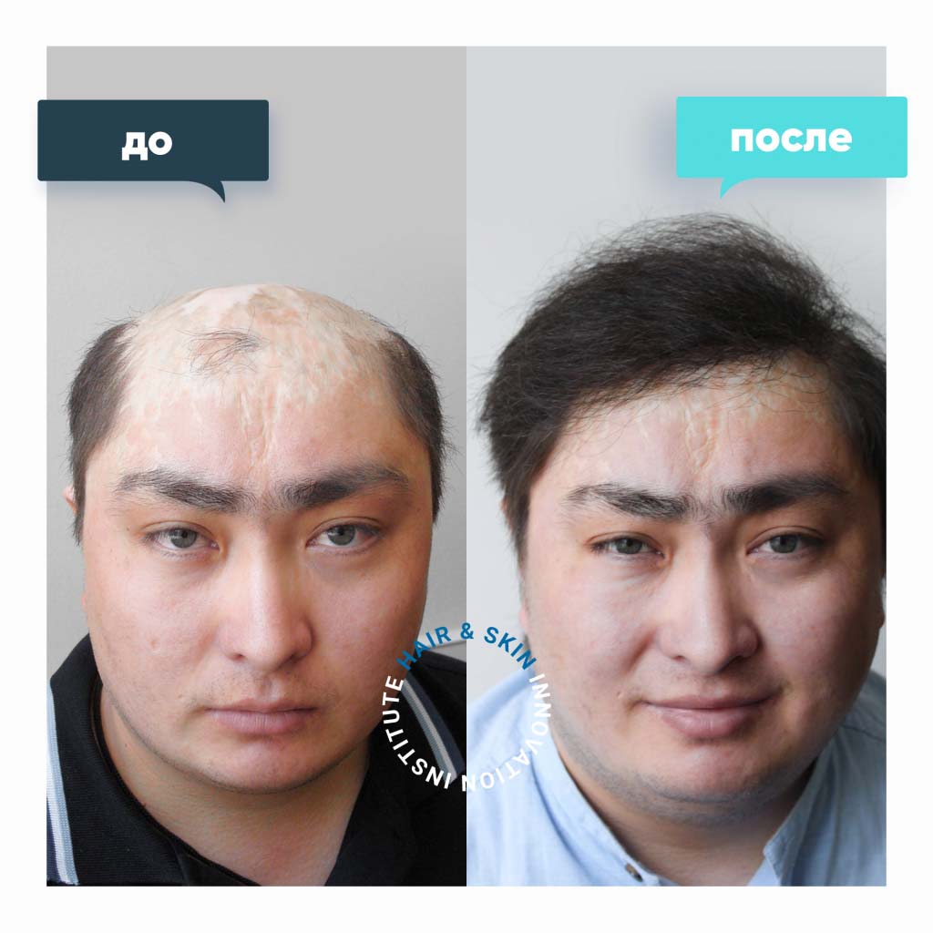 Фотографии до и после трансплантации волос