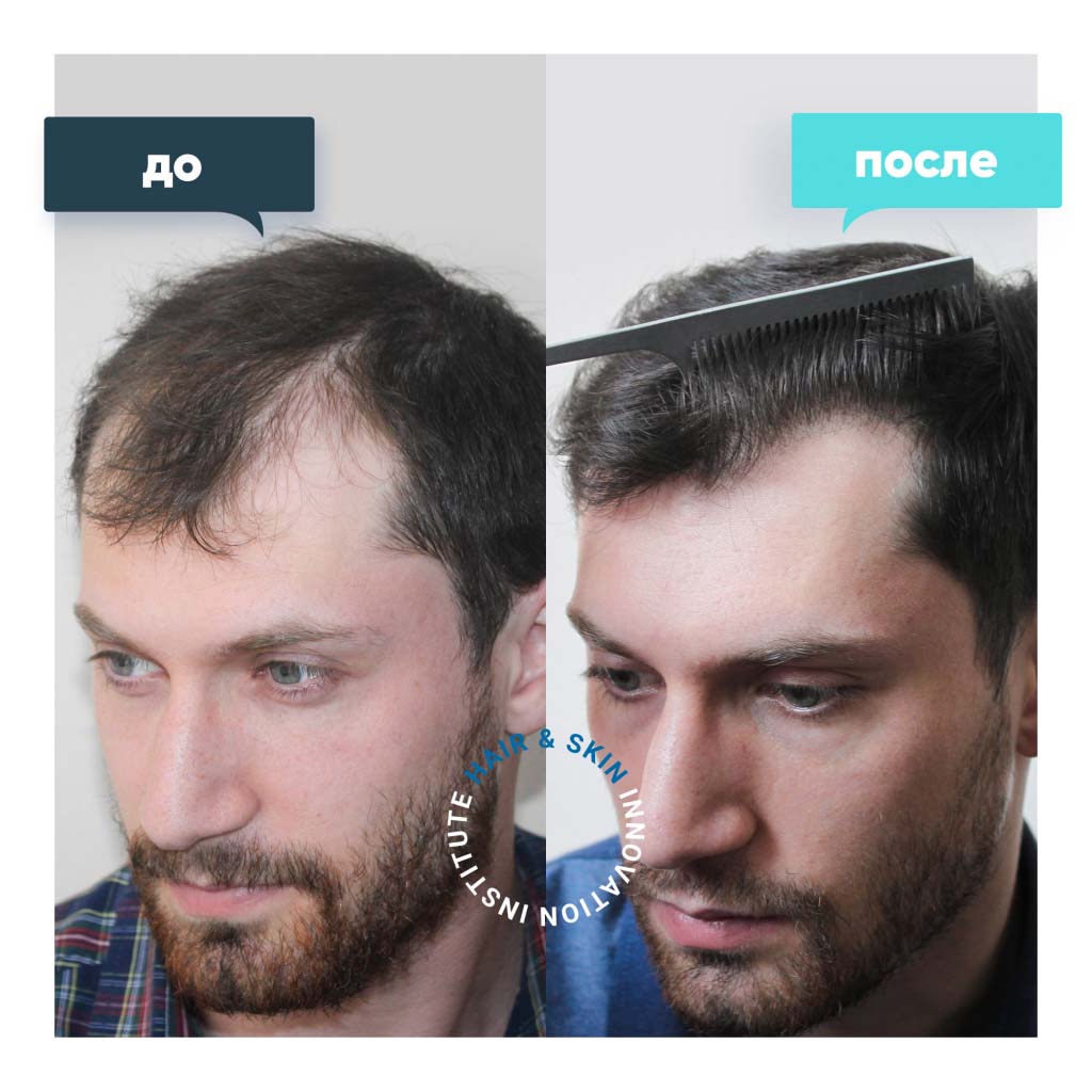 До и после пересадки волос у мужчин